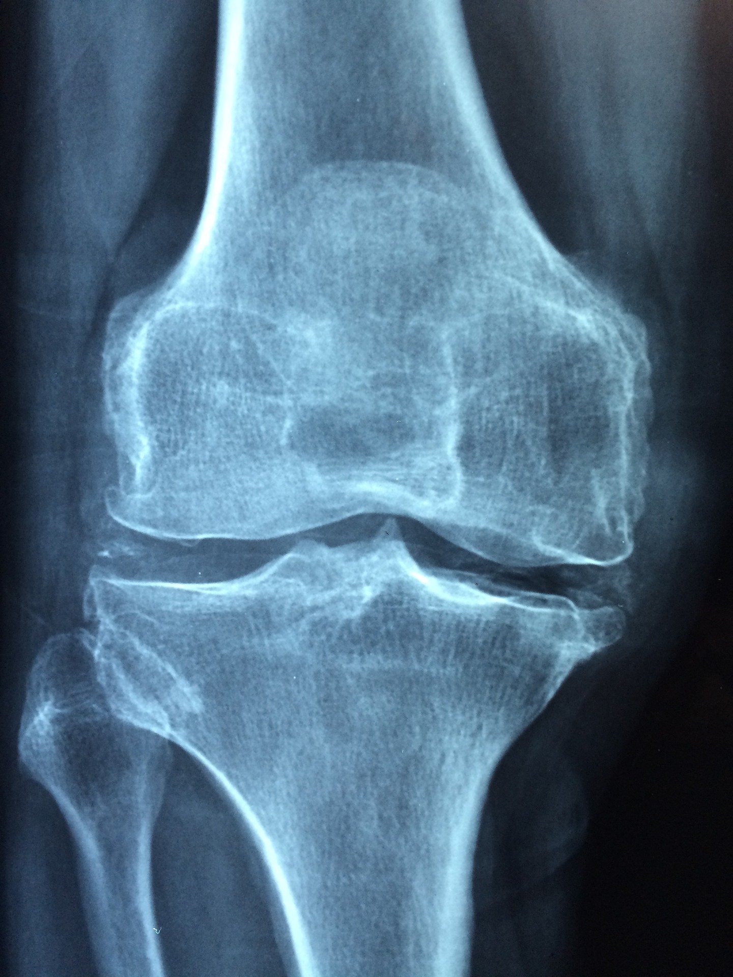 Knee joint scan