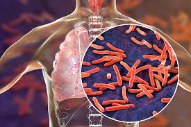 Tuberculosis stock image