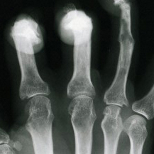 Finger xray