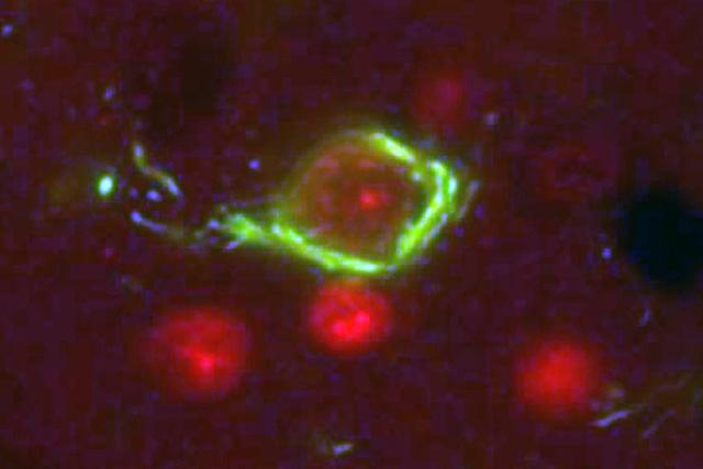 Defective tau proteins form insoluble neurofibrillary tangles (green) that cause neurons to die. 